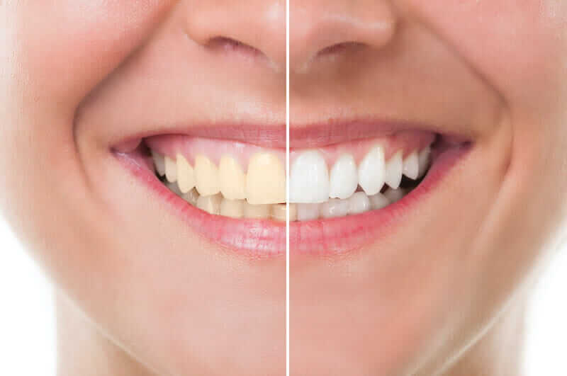 rendre vos dents plus blanches