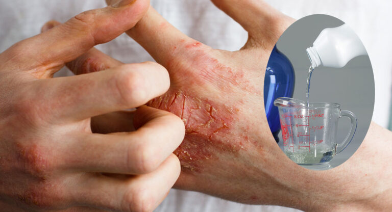 Remèdes naturels contre l'eczéma