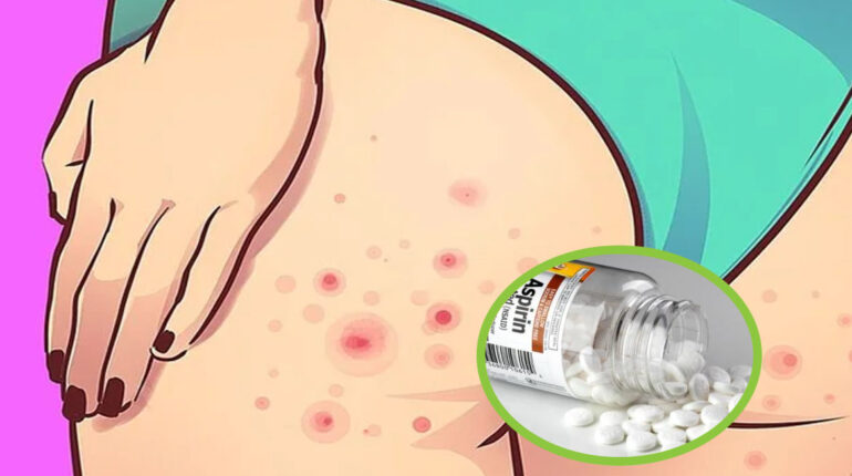 Aspirine : 10 utilisations qui prouvent que la vieille pilule blanche a plus à offrir que ce que l’on croyait 10 choses surprenantes 10 utilisations incroyables de l’aspirine 4 comprimés d'aspirine écrasés 7 pilules d'aspirine aspirine broyée cachets d'aspirine écrasés champignons Conserver courbatures crèmes éclaircissantes d'aspirine écrasé dans l'eau du vase démangeaisons causées par les piqûres de moustiques des cheveux sains et brillants Des pellicules. douleurs du soulagement temporaire de la fièvr écorce Écrasez 2 ou 3 pilules Éliminer les callosités des pieds Empêcher la formation de pellicules Enlever les taches de sueur de vos vêtements exfoliez les zones dures Fait office d'exfoliant flocons de neige fusarien insectes utiles l'aspirine l'aspirine à l'eau du vase L'aspirine aide à calmer l'acné L'aspirine contient un ingrédient liposoluble l'aspirine dans votre jardin l'aspirine en jardinage L'aspirine est un excellent exfoliant l'aspirine peut faire pour vous l'écorce de saule L'utilisation de l'aspirine la période de végétation la santé de la plante les avantages de l'aspirine les fleurs coupées les maladies fongiques les peaux mortes les plantes traitées les plants de tomates les roses médecin mélangés à votre shampooing nettoyants pour la peau pilule blanche pilule d'aspirine dissoute plantes Prolonger la vie des fleurs pulvérisé Réduire l'acné réduire la taille des pores dilatés réduire le gonflement Réduire les taches cutanées rendre la plante des pieds plus douce répandues Réparer les cheveux abîmés Retirer les résidus de savon dans la baignoire se débarrasser de l'excès de sébum ses propriétés anti-inflammatoires soulagement temporaire de la fièvre soulager la douleur et la fièvre Soulager les piqûres d'insectes végétation Votre cuir chevelu