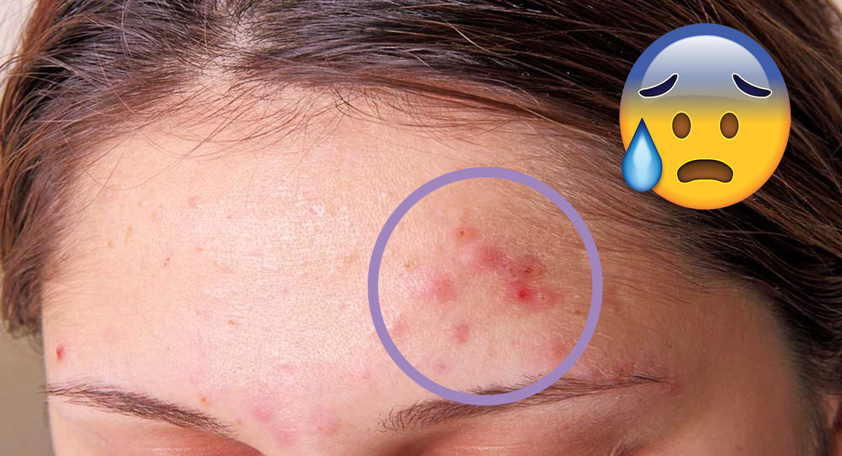 zones d'acné signification