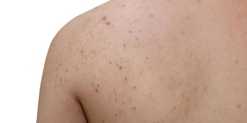 Remèdes maison pour traiter l'acné du dos