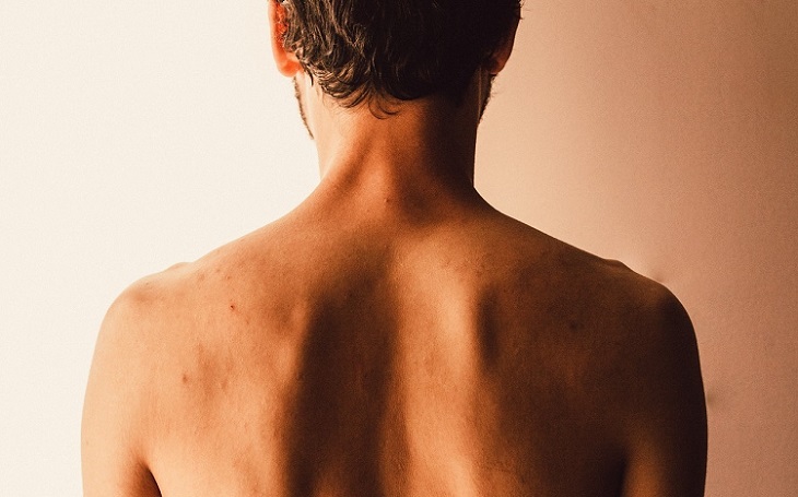 Les causes de l'acné du dos