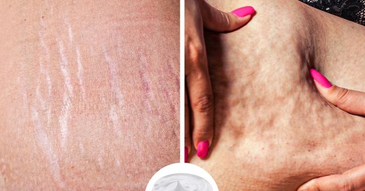 Les crèmes contre la cellulite et les vergetures